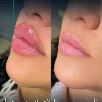 کلینیک پوست زیبایی تزریق ژل390مزوprp لیزر لاغری|خدمات آرایشگری و زیبایی|تهران, ستارخان|دیوار