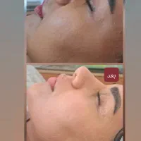 اموزش پاکسازی پوست و مزونیدلینگ و هایفوتراپی