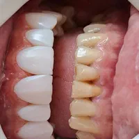 کامپوزیت دندان|خدمات آرایشگری و زیبایی|نورآباد, |دیوار