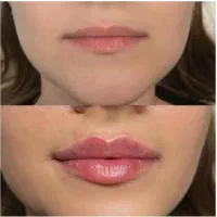 ژل و بوتاکس 550آموزش4م.باکمترین هزینه بدرخشید.|خدمات آرایشگری و زیبایی|شهریار, شهریار|دیوار