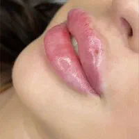 جشنواره پاییزه ژل وبوتاکس