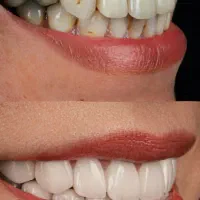 دندانپزشکی از دم قسط ایمپلنت کامپوزیت عصبکشی روکش|خدمات آرایشگری و زیبایی|خرمآباد, |دیوار