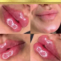 ژل بوتاکس،لابیاپلاستی،حذف لک،ریموو تتو،لاغری|خدمات آرایشگری و زیبایی|ارومیه, |دیوار