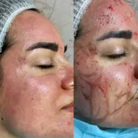 تخلیه لک بامتد پکینگ اپ گاز