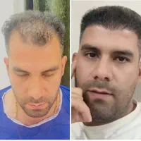 کاشت مو VIP شیراز در یزد،با ۲۱ سال سابقه درخشان