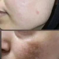 فرمولاسیون کرم های لکه بر سفیدکننده
