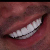 دندانپزشکی کامپوزیت فکی ۱۸/ بلیچینگ ۴/۵ عصب کشی۴/۵