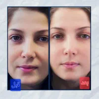 جشنواره کلینیک تزریق ژل لبMلیفت لیزر جوانساز آنزیم