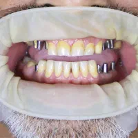 ایمپلنت با روکش تمام سرامیک ۱۵.۹۰۰ پذیرش محدود|خدمات زیبایی و سلامت|تهران, آسمان|دیوار