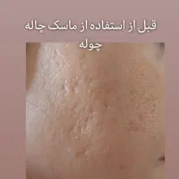 ماسک چاله چوله و منافذ باز صورت