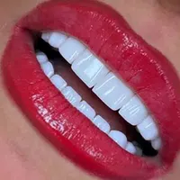 کامپوزیت دندان،روکش،عصب کشی،لمینت