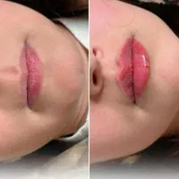 جشنواره ژل لب فیلرمزو1050بوتاکس950 پزشک متخصص|خدمات زیبایی و سلامت|مشهد, سجاد شهر|دیوار