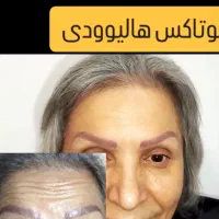 بوتاکس طبیعی درهرسنی|خدمات آرایشگری و زیبایی|رشت, بلوار گیلان|دیوار