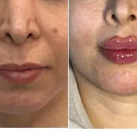 تزریق ژل و بوتاکس و مزوتراپی/ژل لب M تکنیک|خدمات آرایشگری و زیبایی|مشهد, نیروی هوایی|دیوار