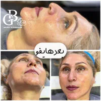 فیشیال.کربن.لیزر.لاغری.هایفو|خدمات آرایشگری و زیبایی|کرج, کوی زنبق|دیوار