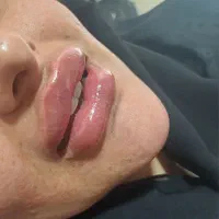 آف ویژه ژل بوتاکس مزو|خدمات آرایشگری و زیبایی|اسلامآباد غرب, |دیوار