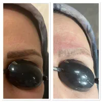 ریمو تتو و کک ومک و کربن تراپی با لیزر کیوسوئیچ