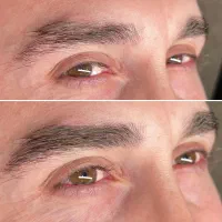 میکروبلیدینگ فوق طبیعی آقایون