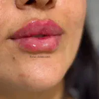 فیلر بوتاکس ب مناسبت یلدا