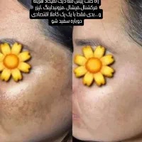 پک صورت گیاهی ضدلک و کک مک|آرایشی، بهداشتی، درمانی|آباده, |دیوار