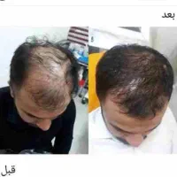 مزوتراپی مو (قطع ریزش)
