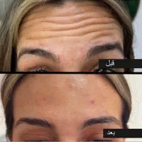 بوتاکس فقط ۹۵۰ ( پیشانی لبخند لثه ای زیر بغل و..)