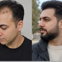 کاشت ممنوع شد
