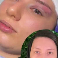 آموزش بلفاروپلاستی لیزری|خدمات آموزشی|تهران, ونک|دیوار