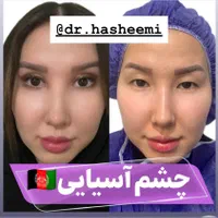 بلفارو پلک فیلر ژل لب ساکشن غبغب بوتاکس نخ سانترال|خدمات آرایشگری و زیبایی|اصفهان, مرداویج|دیوار