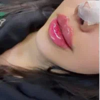 تزریق ژل بوتاکس