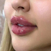 تزریق ژل از ۱۴۹۰ ،بوتاکس از ۶۵۰، پکیج فول فیس ۹/۵|خدمات آرایشگری و زیبایی|تهران, گلستان (شهرک راه آهن)|دیوار