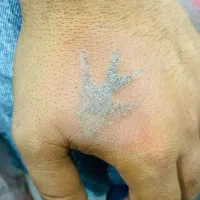 ریموو تتو (پاک کردن تتو)