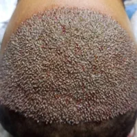 کاشت مو طبیعی با جدید ترین روشfitوسوپرfut|خدمات آرایشگری و زیبایی|اهواز, زیتون کارمندی|دیوار
