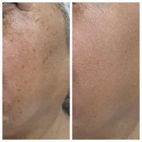 تزریق ژل و بوتاکس، ژل لب روسی و آموزش و ارائه مدرک|خدمات آرایشگری و زیبایی|کرج, شاهین‌ویلا|دیوار