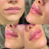 آموزش و تزریق ژل و بوتاکس