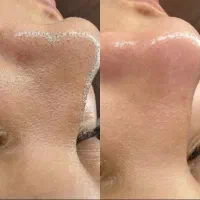 پاکسازی تخصصی  پوست|خدمات آرایشگری و زیبایی|دهدشت, |دیوار