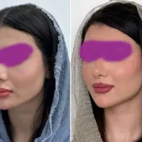 بایو فیلر متد اروپایی کلینیک فرحزاد|خدمات زیبایی و سلامت|اصفهان, عباسآباد|دیوار
