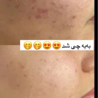 فیشال تخصصی خانم ها واقایان تحت نظر پزشک|خدمات آرایشگری و زیبایی|زاهدان, |دیوار