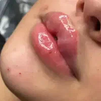 تزریق ژل لب و بوتاکس فقد سی سی ۵۰۰
