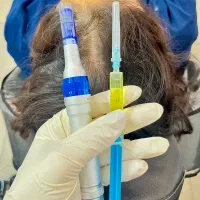 مزوتراپی مو مزونیدلینگ موفقط ۶۵۰ریزش مو رویش مجدد