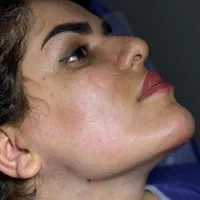 تزریق چربی و‌تخلیه غبغب به روش زاویه سازی|خدمات آرایشگری و زیبایی|اهواز, پادادشهر|دیوار