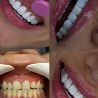 اف ویژه کامپوزیت دندان