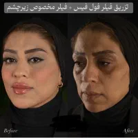 بوتاکس پیشانی،خط اخم رایگان شد توسط پزشک|خدمات آرایشگری و زیبایی|کاشان, بهشتی|دیوار