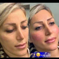 فیلر بوتاکس لیزر فیلربادی لاغری مزوتراپی prp جراحی|خدمات آرایشگری و زیبایی|مشهد, هنرستان|دیوار