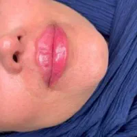 ژل ، بوتاکس ، چربی ، فیلر|خدمات آرایشگری و زیبایی|کرمانشاه, |دیوار