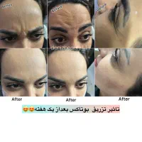 جشنواره تزریق ژل و بوتاکس (توسط پزشک)|خدمات آرایشگری و زیبایی|اصفهان, عباسآباد|دیوار