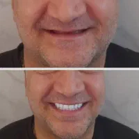 دندان سازی، دست دندان مصنوعی ،فلکسیبل ژله ای،روکش