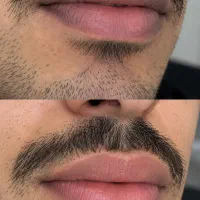 رفع کبودی لب وتیرگی لب آقایان (اصلاح رنگ طبیعی لب)