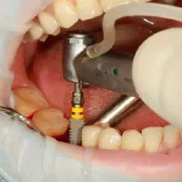 ایمپلنت با شرایط اقساطی به همراه کشیدن رایگان