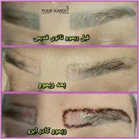 ریموو ابرو چشم لب آنزیم تراپی نانوبروز مدل آموزش